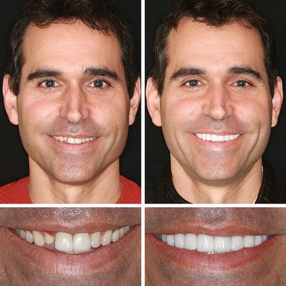 Ends Today: 70% OFF! ⏰70% OFF! EETTSY™ Medical Full Denture with Strong Suctiond Custom-Fit Full Functional Dentures🦷Obtain American Dental Association (ADA) Certification